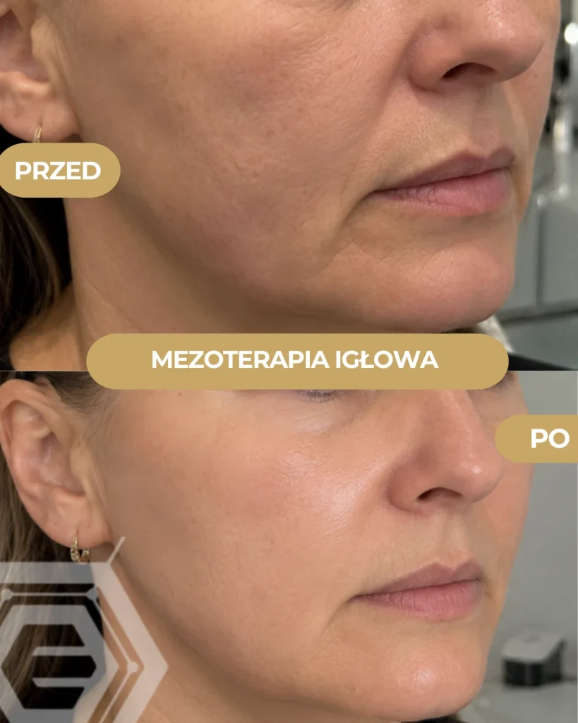 realizacja mezoterapia przed i po