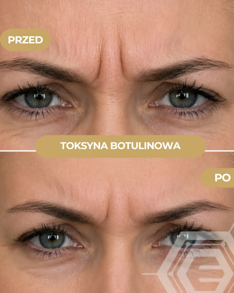 realizacja toksyna botulinowa przed i po
