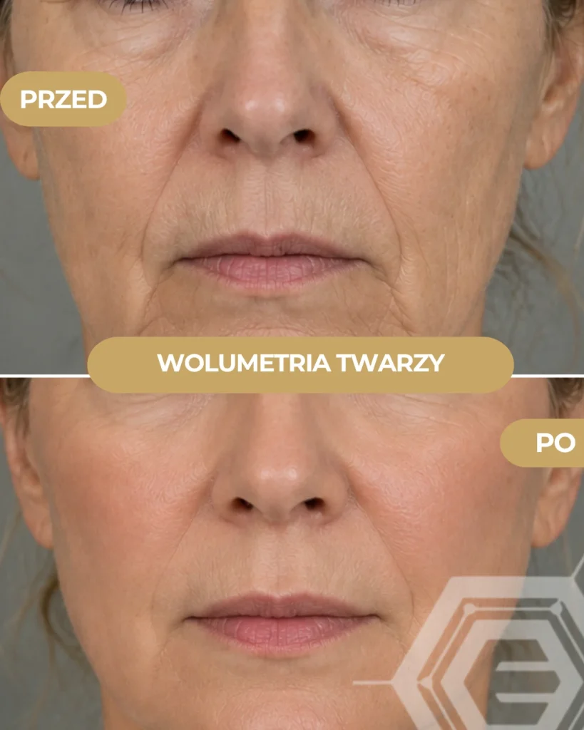 realizacja wolumetria twarzy przed i po